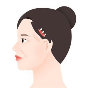관자거상 — 두피 안쪽 절개 위치 그림