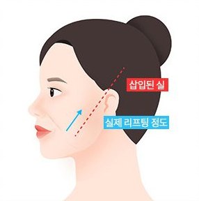 특수 실리프팅 — 실 삽입 위치와 리프팅 방향 그림